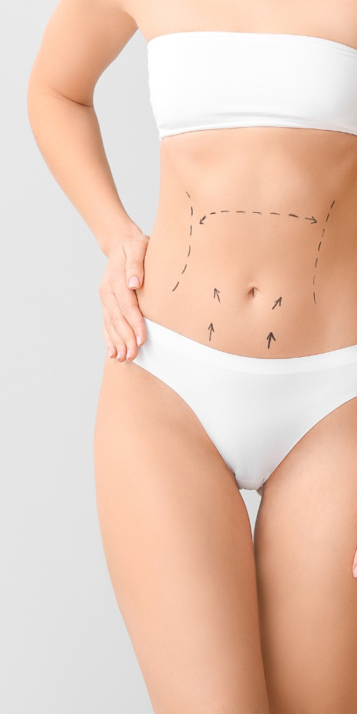 liposuction drawn out on belly image